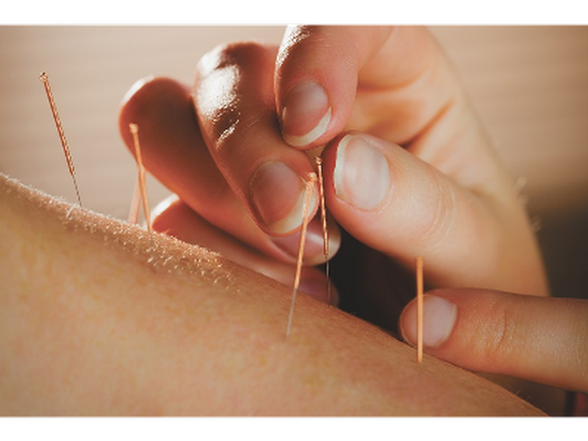 Consultation and Acupuncture Treatment